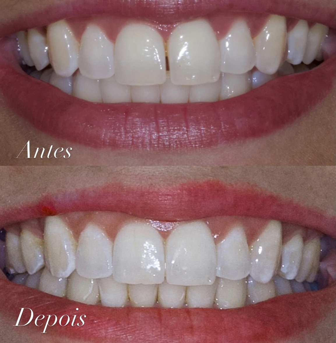 Antes e depois de um caso tratado: dentes girados na frente, e depois alinhados